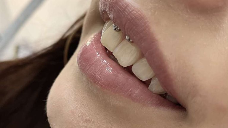 Smiley piercing