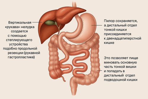 Gastric biliopancreatic diversion