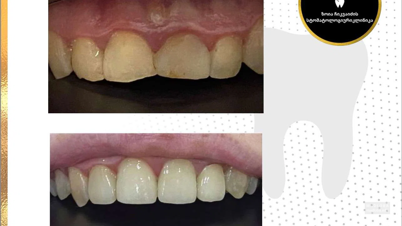 Зубы до и после