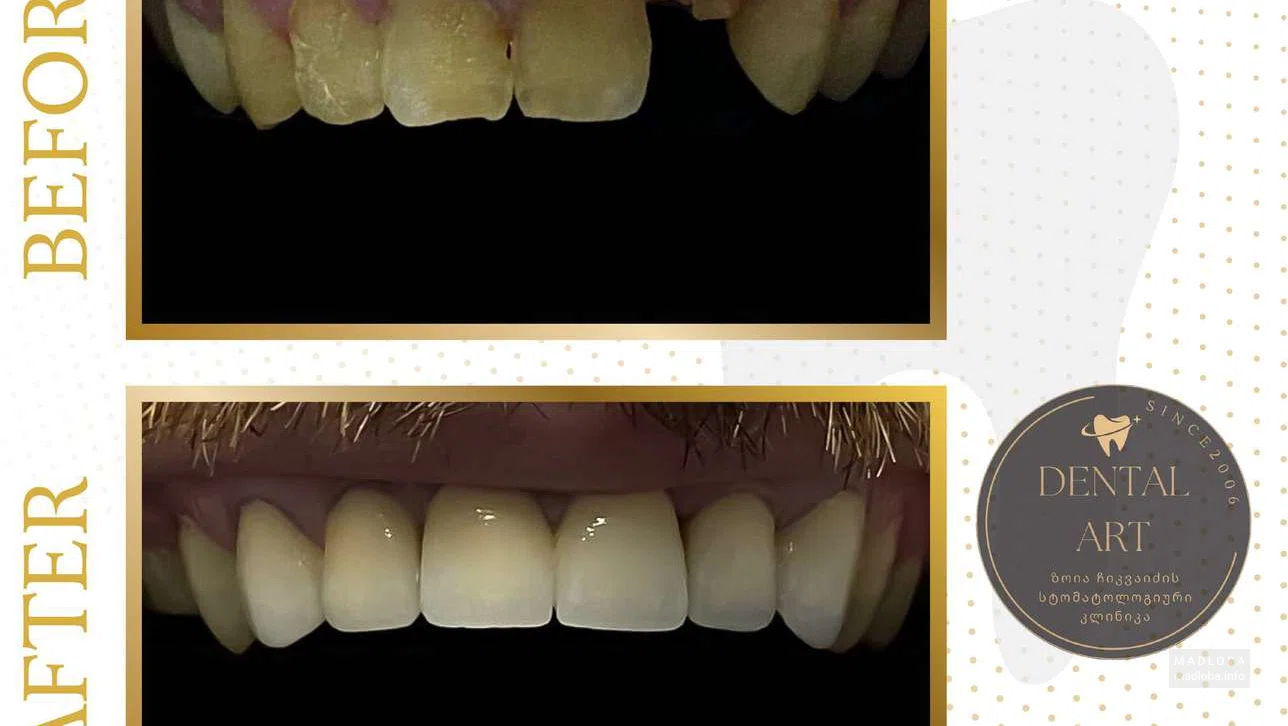 Зубы до и после