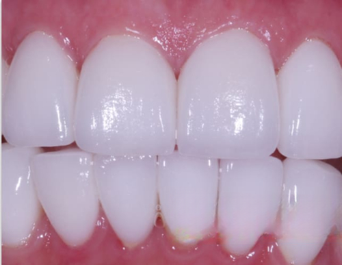 ceramic veneers