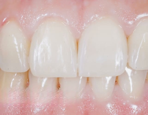 composite veneers