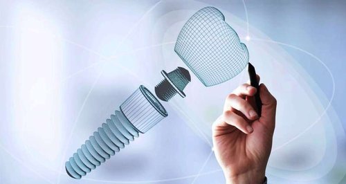 dental implant
